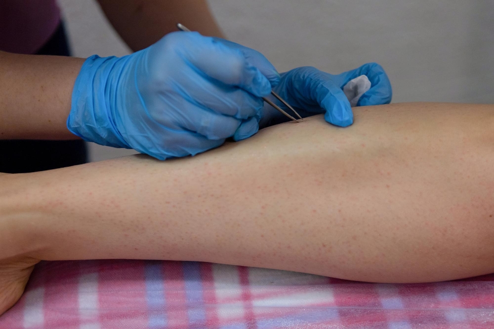 (IMS) Dry Needling-img-2