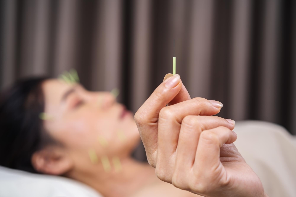 Acupuncture in Surrey