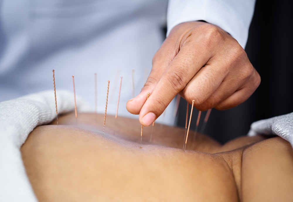Acupuncture in Langley