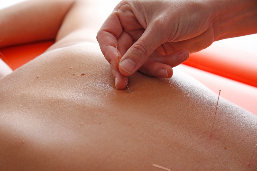 Acupuncture in Vancouver