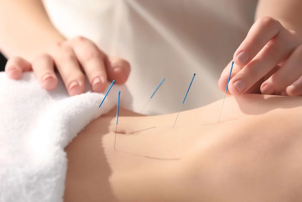 Acupuncture in Surrey