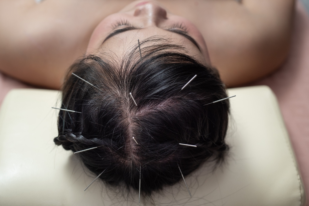 Acupuncture in Surrey