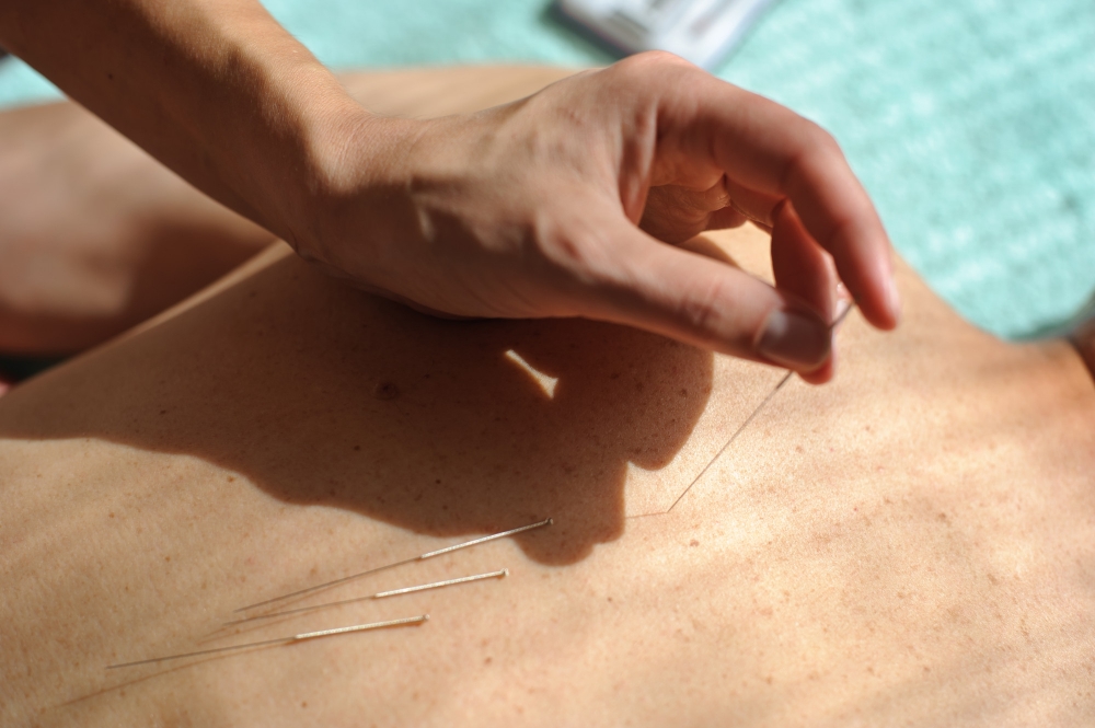 Acupuncture in Richmond