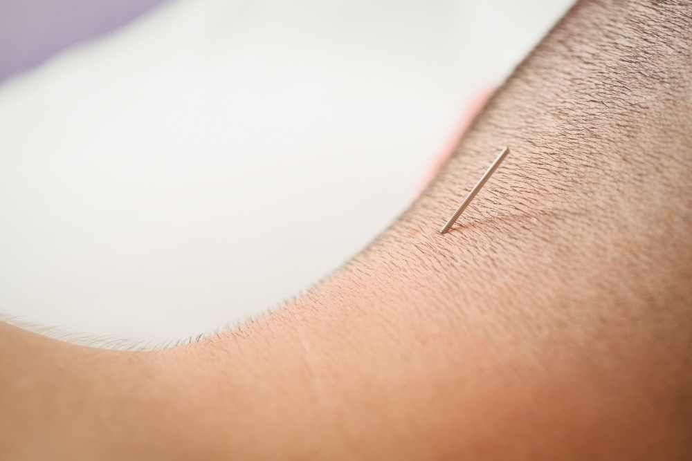 Acupuncture in Richmond