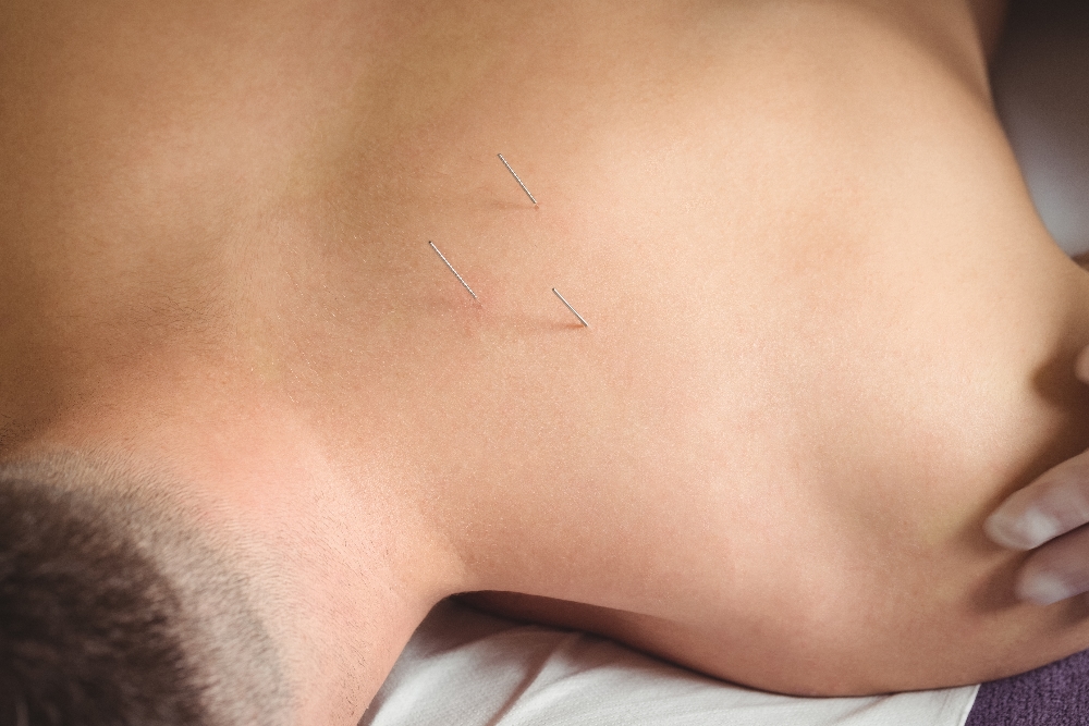 Acupuncture in Richmond
