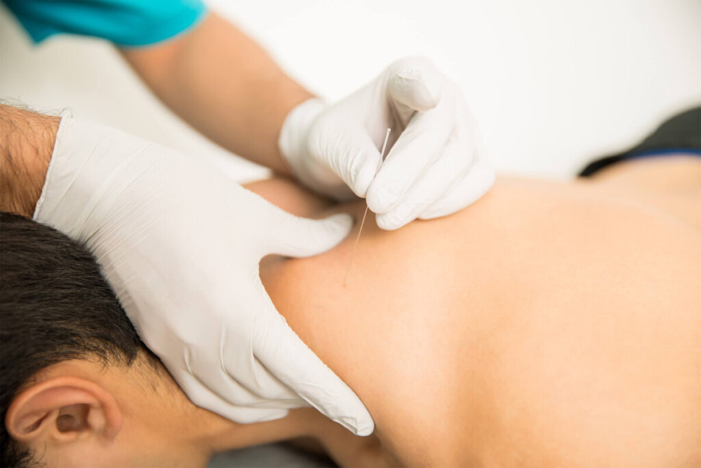 Acupuncture treatment process