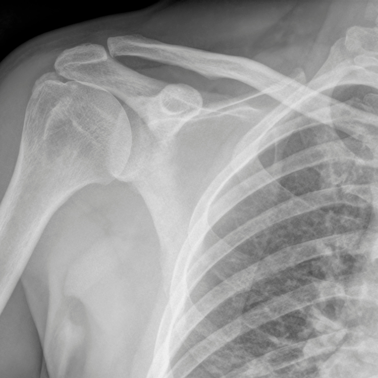 Recovering From Rotator Cuff Tendinopathy: How Exercise Can Help 1 Cuff Tendinopathy