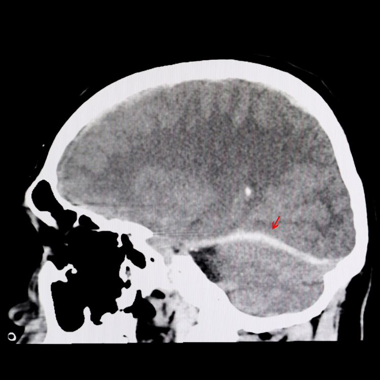 How Concussions Affect Lower Body Injuries And Movement: What You Should Know 1 Neuromuscular Dysfunction