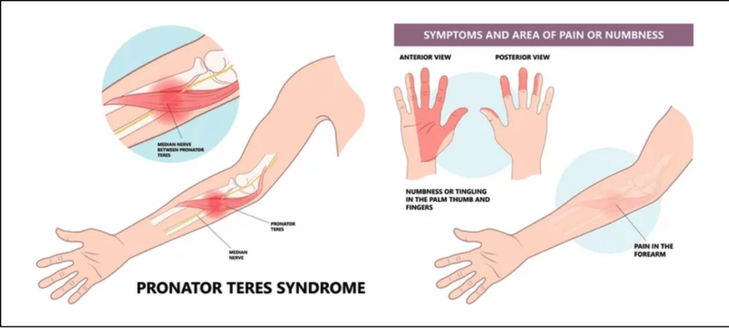 Pronator Teres Syndrome