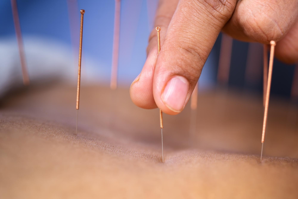 Acupuncture in Queensborough