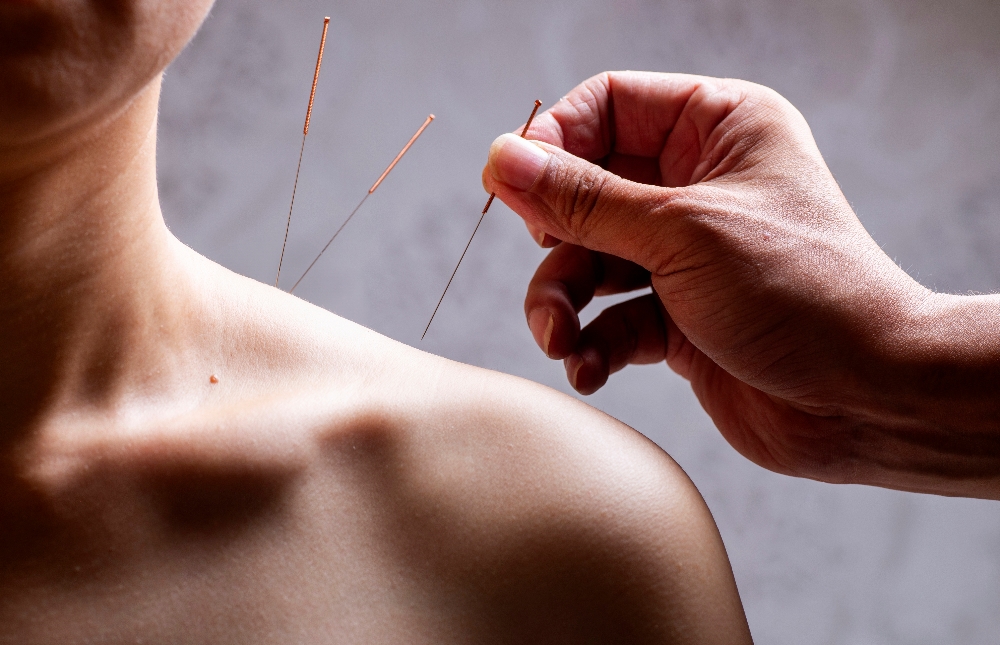 Acupuncture in South Surrey 