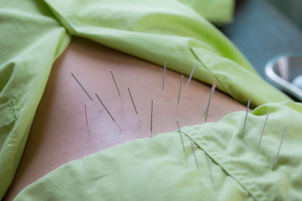 Acupuncture in Queensborough
