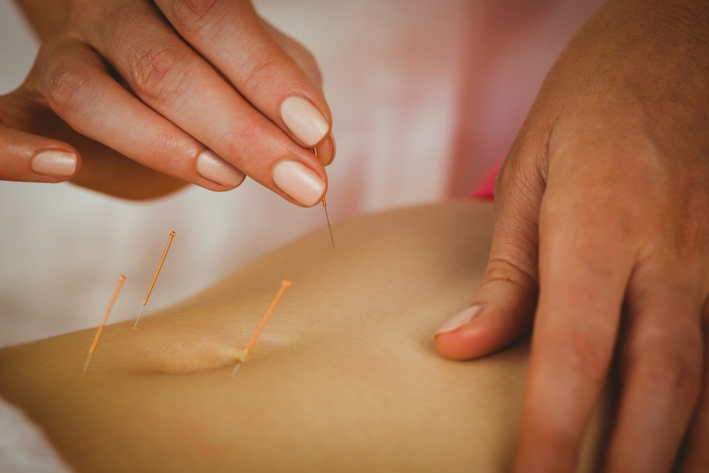 Acupuncture in South Surrey 