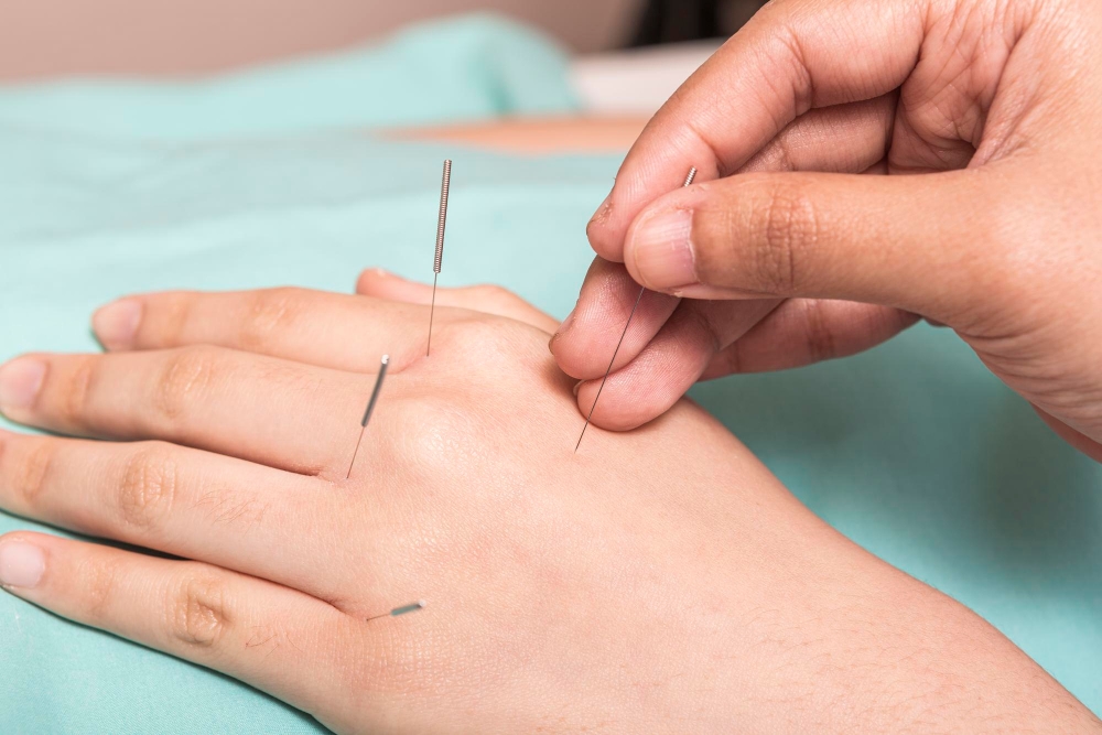 Acupuncture in South Surrey 