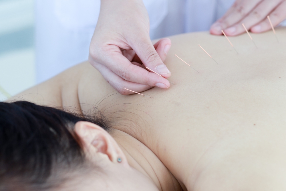 Acupuncture in Queensborough