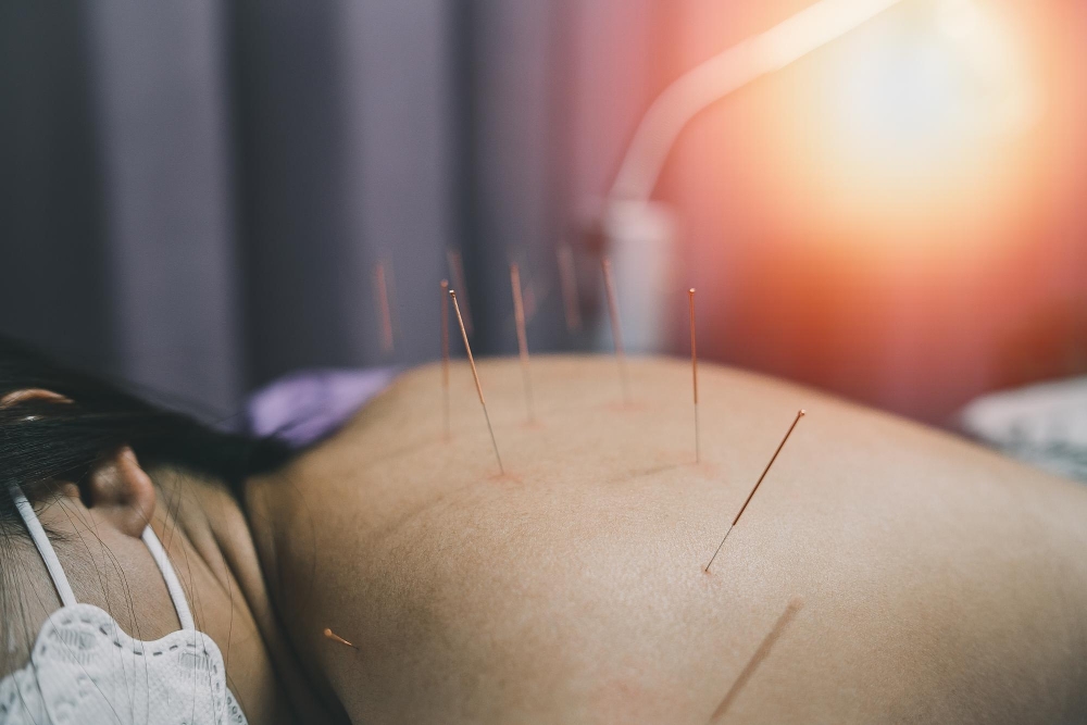 Acupuncture in White Rock 