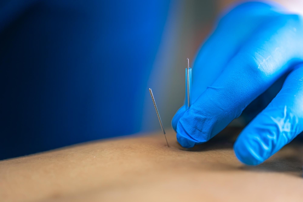Dry Needling in Langley 