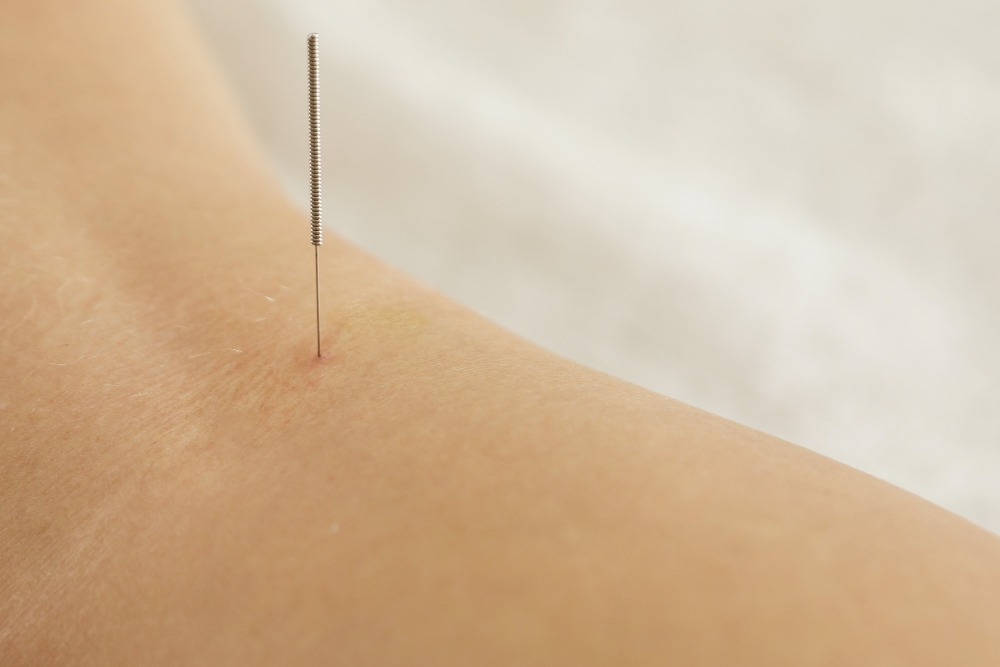 Dry Needling in Langley 