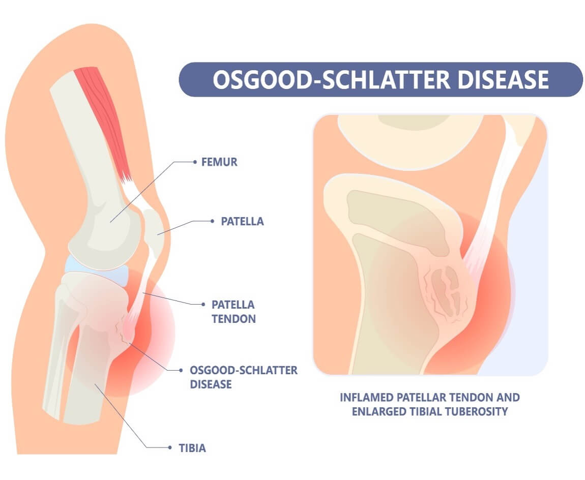 Osgood-Schlatter’s Disease In Kids 1 Osgood-Schlatter’s Disease In Kids | Physiotherapy In Surrey, Langley, Richmond, Ladner
