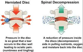 Cervical Traction 2