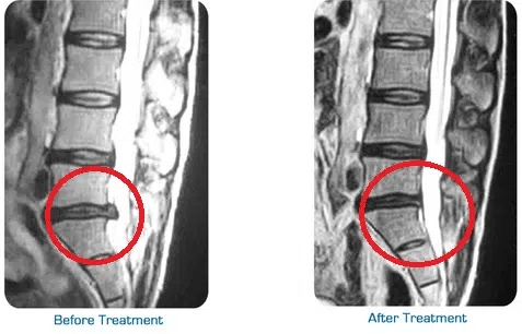 Cervical Traction 3