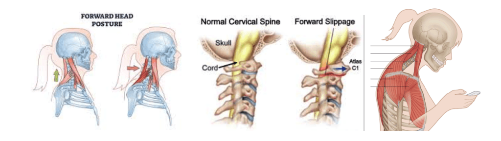 cervical instability