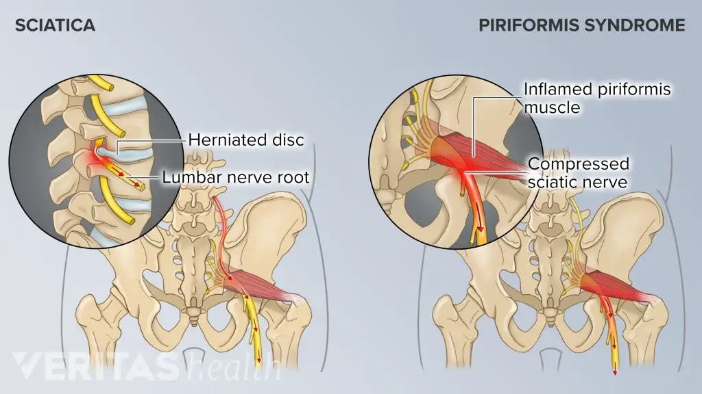 Is It Sciatica or Piriformis Syndrome? How to Treat Gluteand Leg Pain