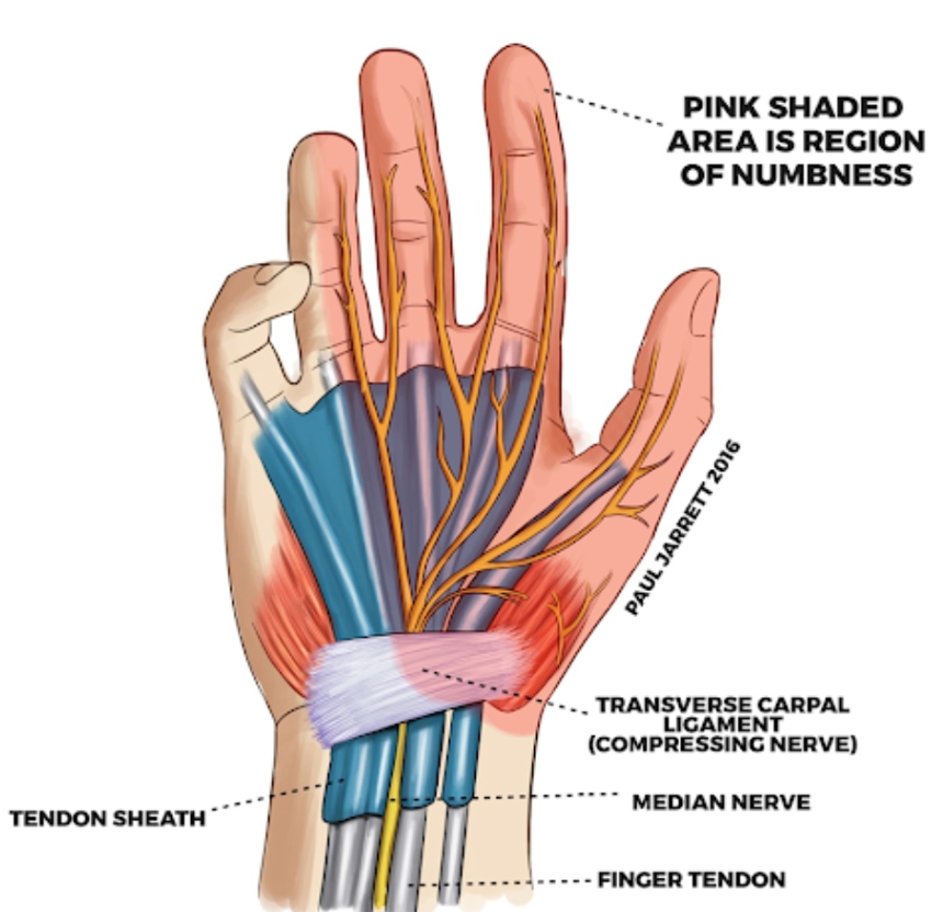 Carpal Tunnel Syndrome: Symptoms, Treatment, and Physiotherapy Recovery