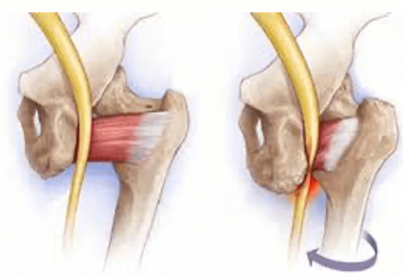 Ischiofemoral Impingement