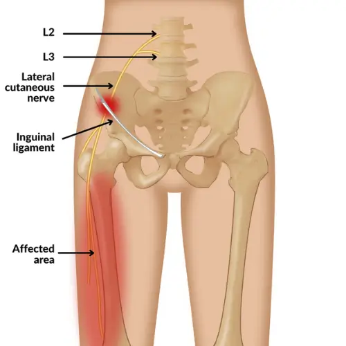 Meralgia Paresthetica