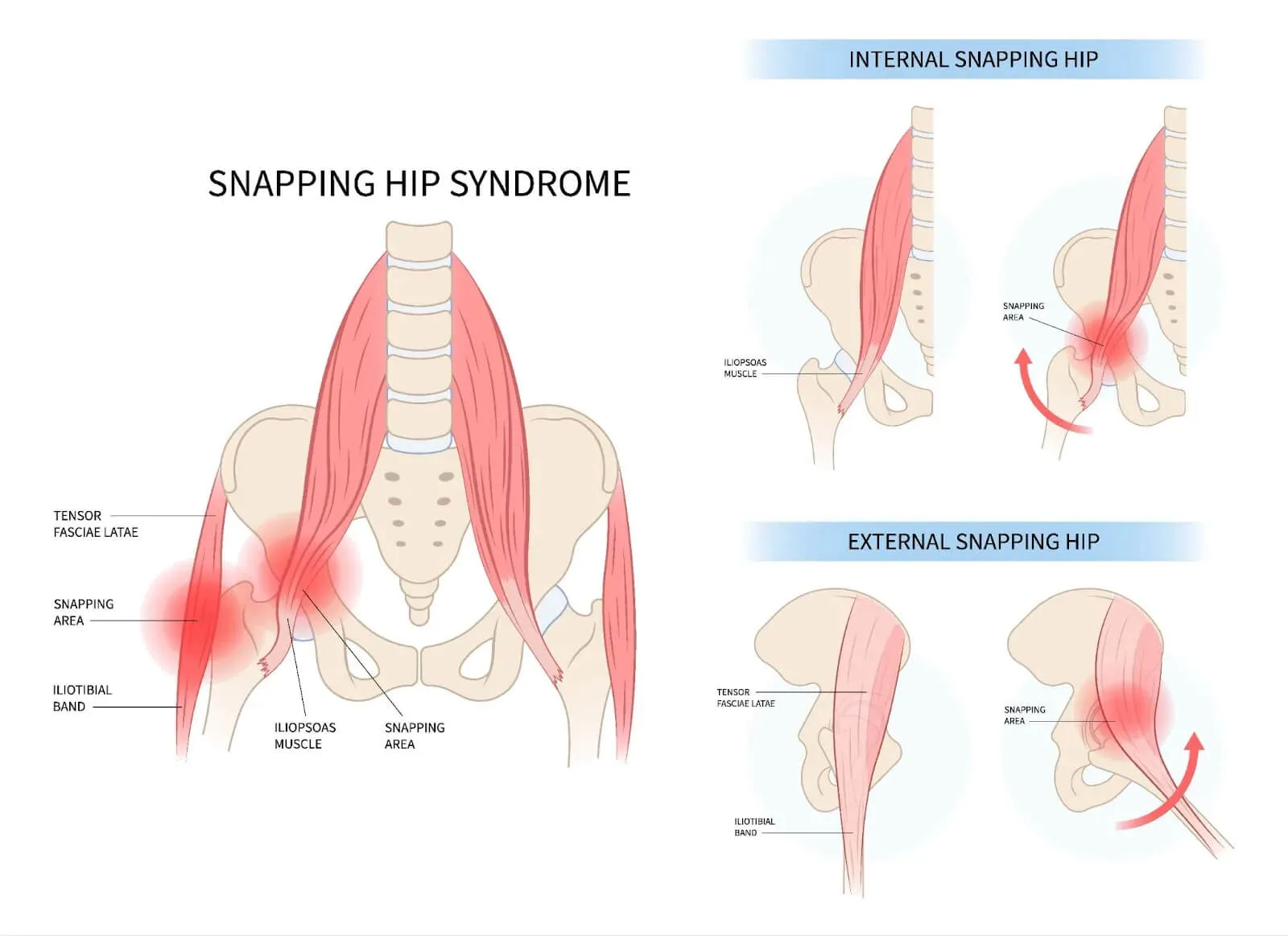 Snapping Hip Syndrome: Why Your Hip Clicks, Pops, or Snaps | Pain Free Health Clinic