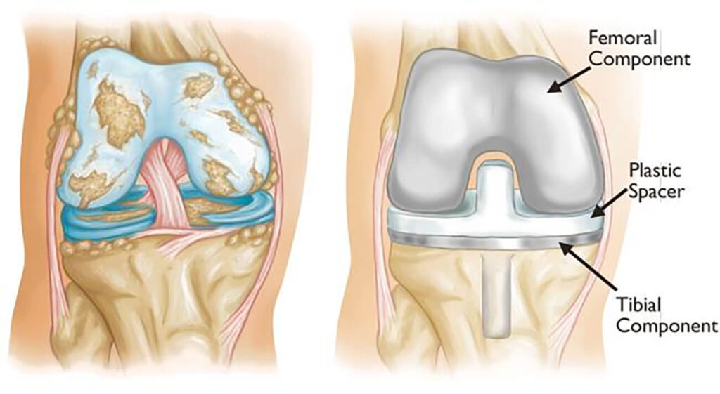 Understanding Knee Replacement &Amp; How To Prevent It