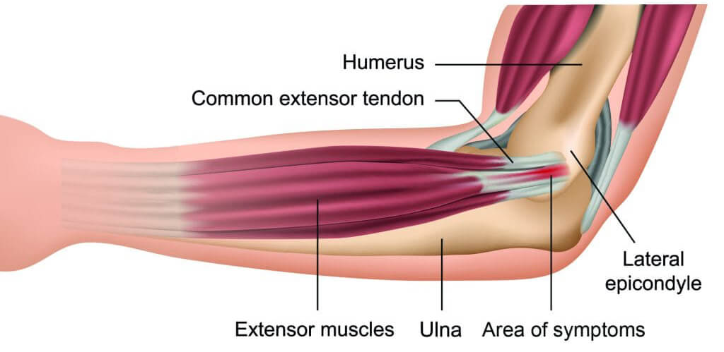 Golfer’s Elbow