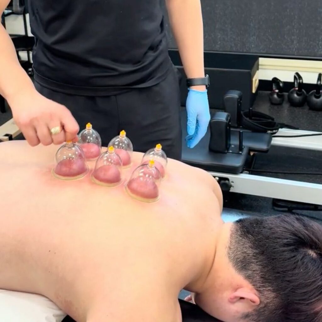 Cupping Therapy For Recovery