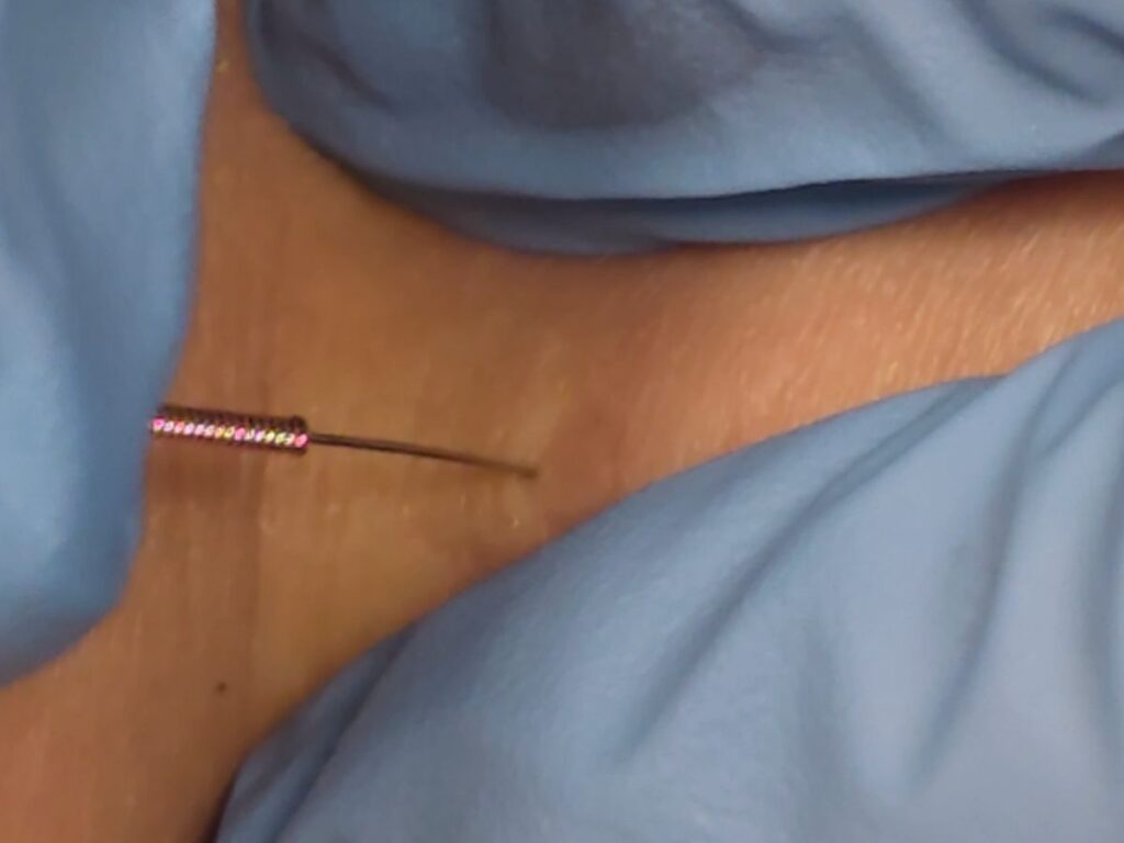 How Dry Needling Works