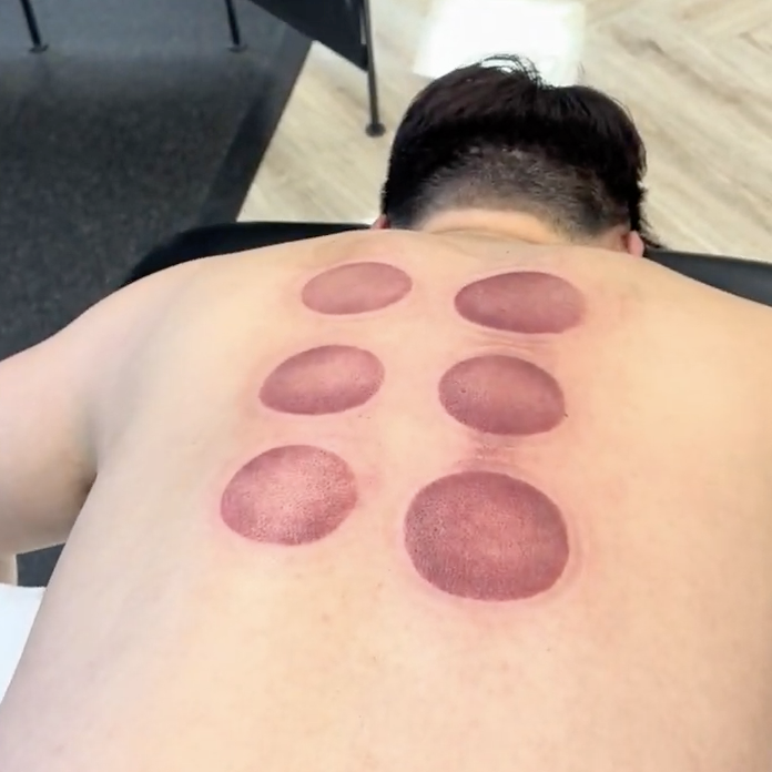 What Are Those Red Circles From Cupping Therapy?