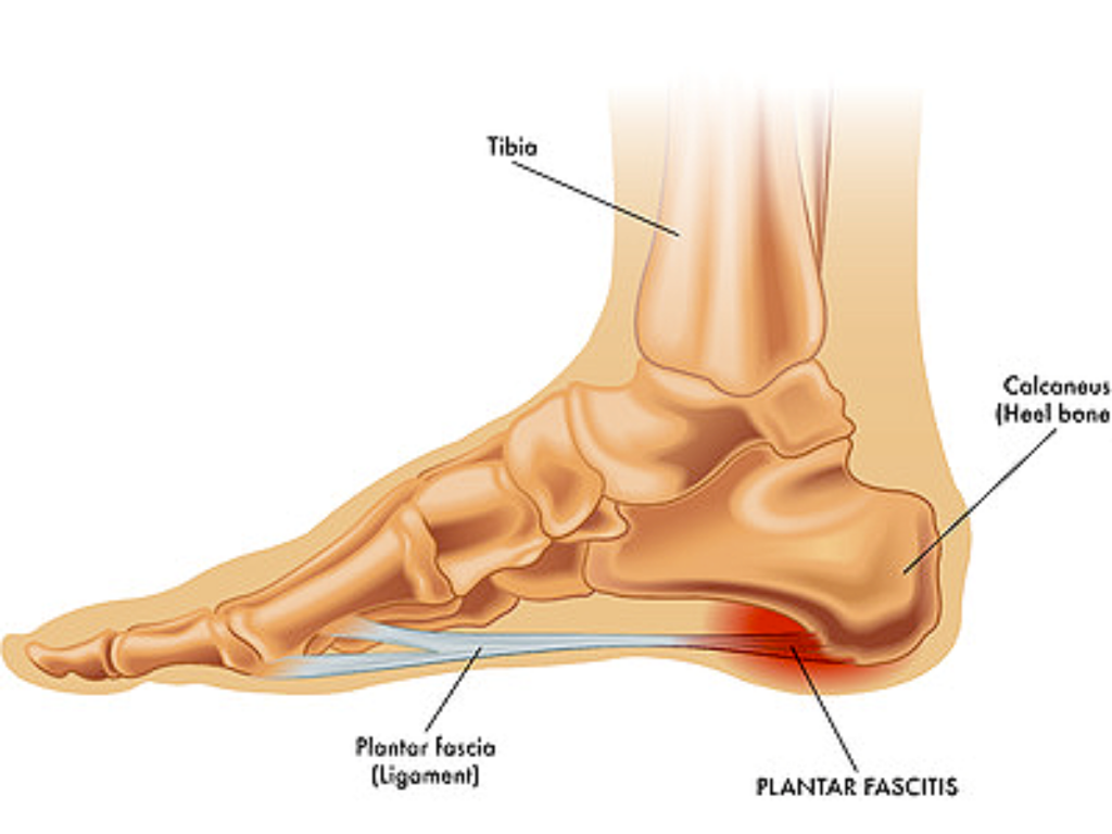 What Is Plantar Fasciitis?