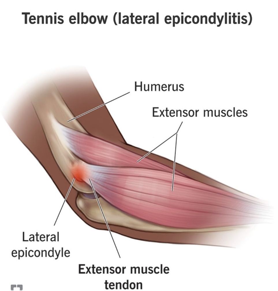 What Is Tennis Elbow?