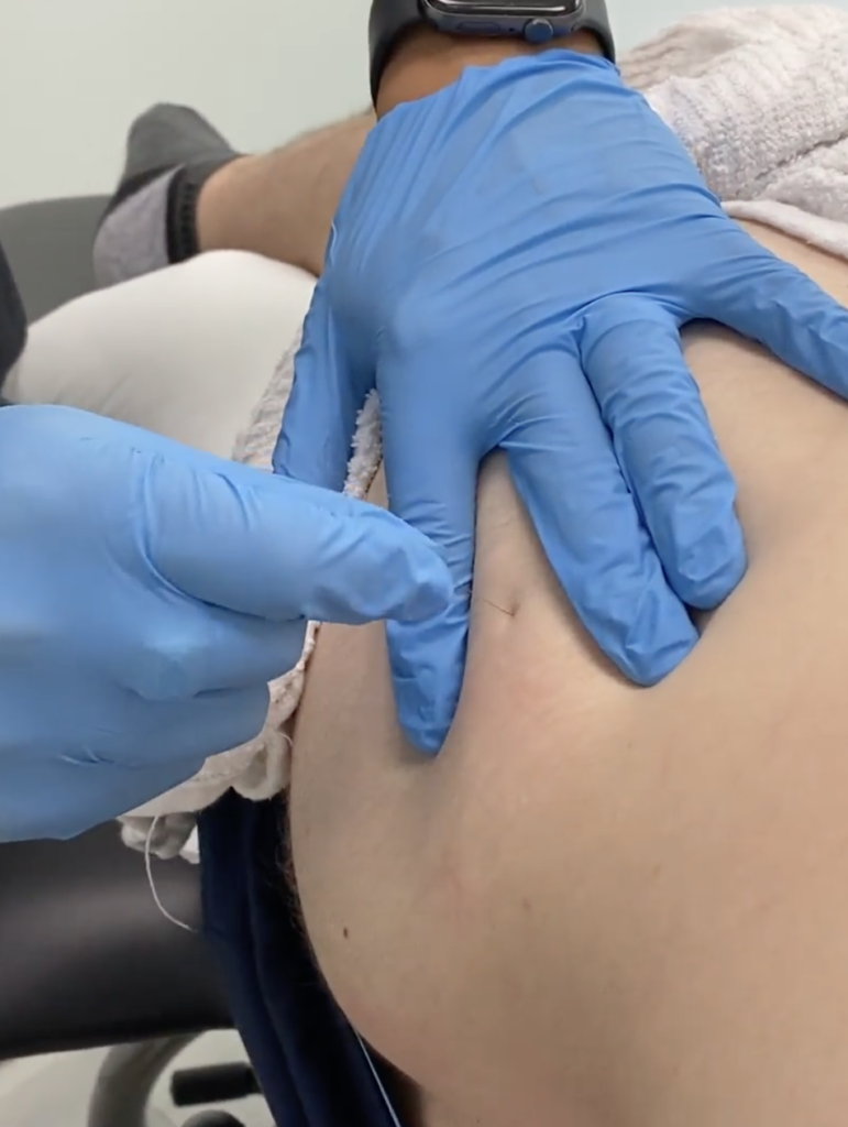 Why Dry Needling Helps Hip Muscle Tension