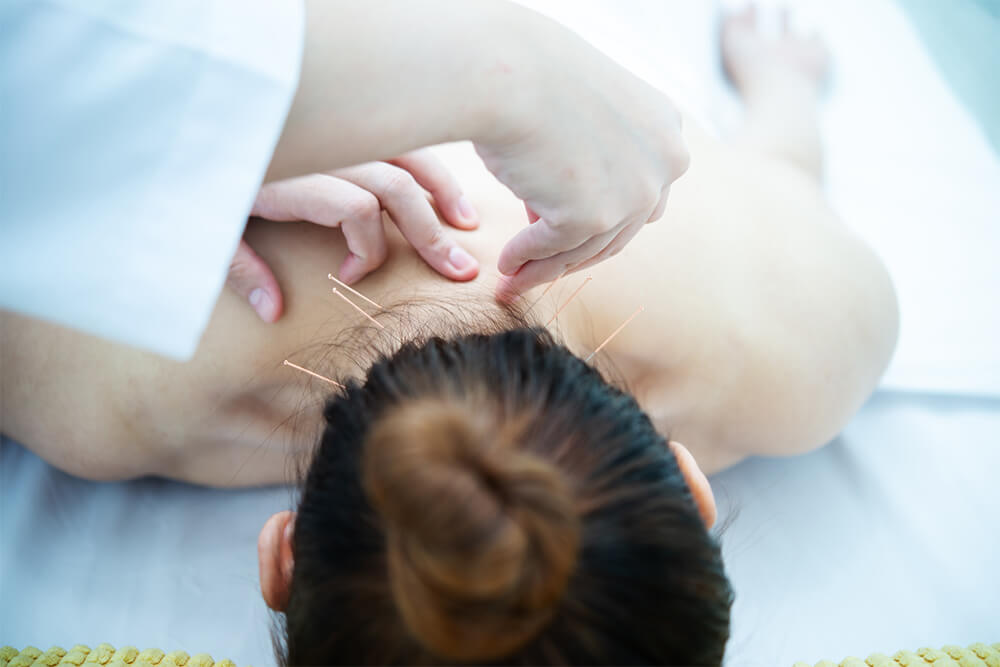 How Does Acupuncture Work Maple Ridge