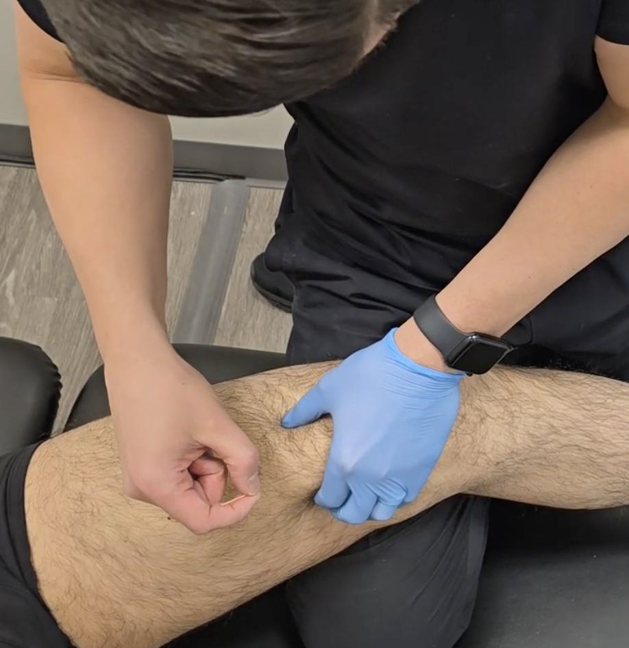 How Dry Needling Helps