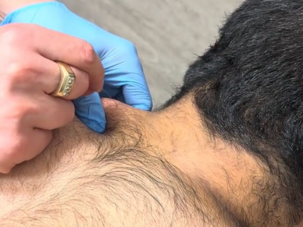 How Dry Needling Helps