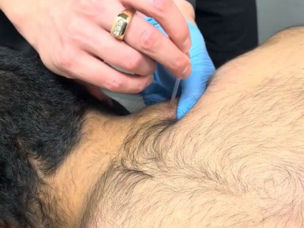 Who Can Benefit From Dry Needling