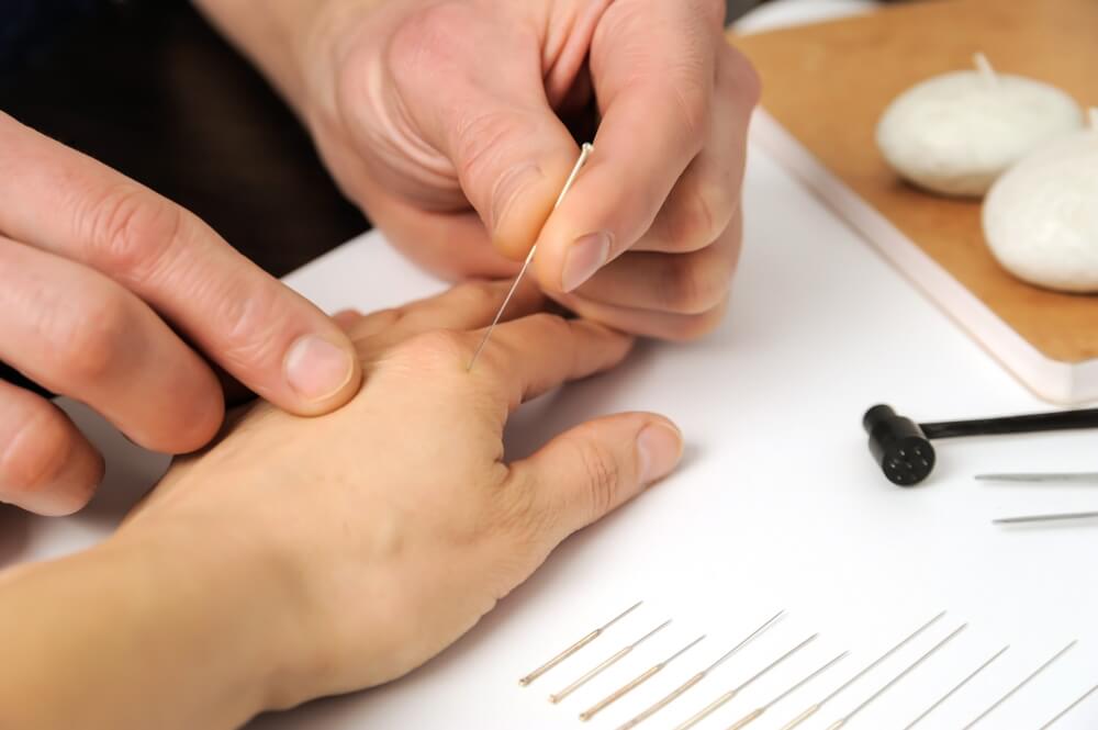 Benefits of Dry Needling