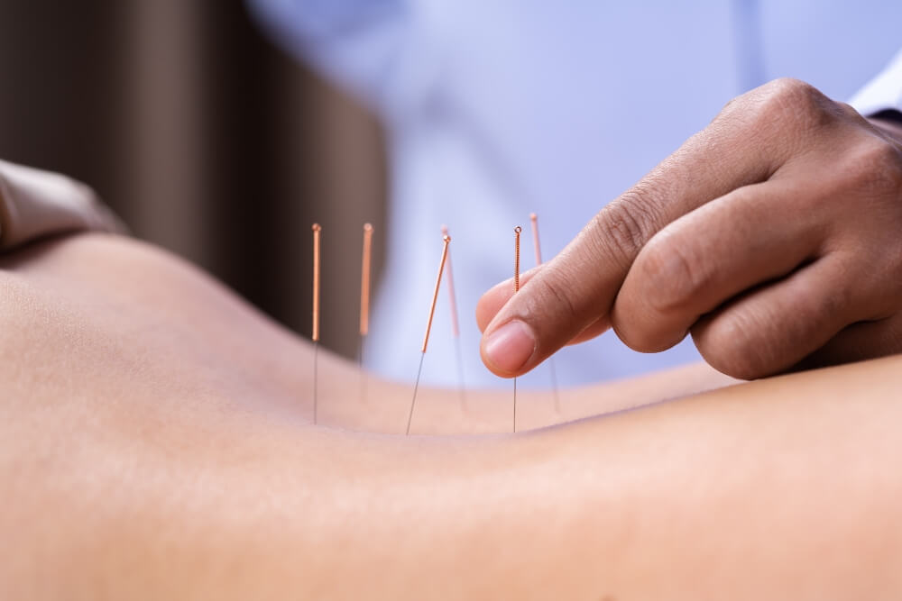 Dry Needling Process Maple Ridge
