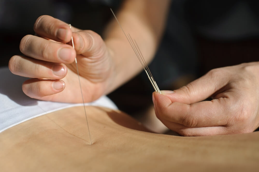 dry needling services in Maple Ridge
