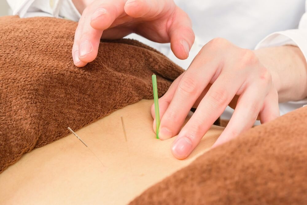FAQ Dry Needling Maple Ridge