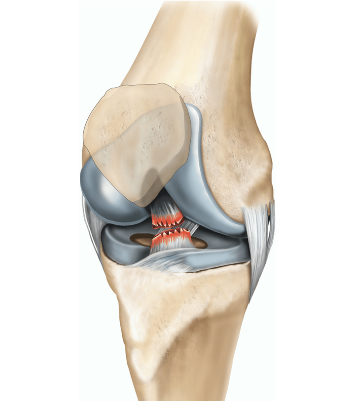 Acl Reconstruction Explained: What Happens During Acl Surgery? 1 A Torn Acl, Image Credit: Https://Www.healthdirect.gov.au/Surgery/Acl-Reconstruction
