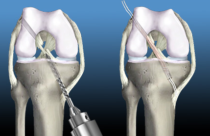 Acl Reconstruction Explained: What Happens During Acl Surgery? 2 Acl Reconstruction, Image Credit: Https://Phoenixshoulderandknee.com/The-Pros-And-Cons-Of-Having-An-Acl-Reconstruction/