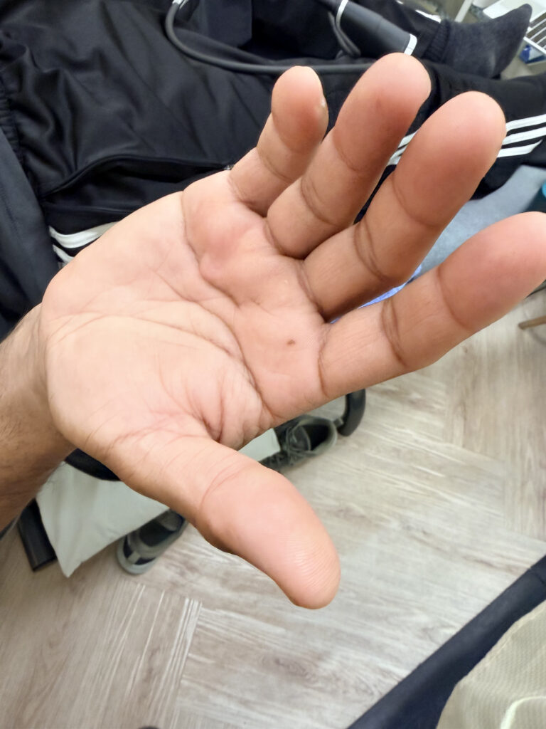 Can'T Fully Open Your Fingers_